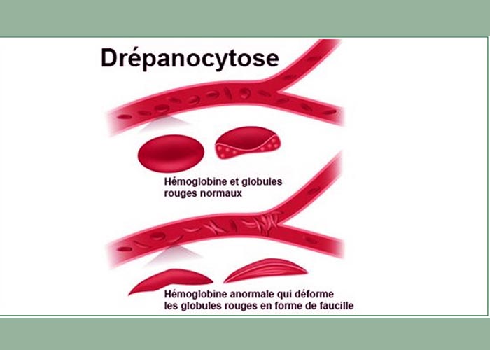 Drépanocytose-sante221