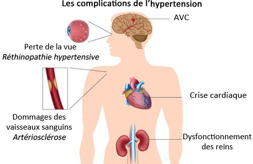 Hypertension-illustation