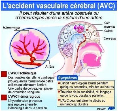 AVC-sante-senegal