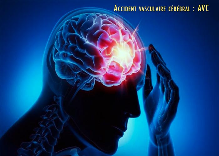 Accident-vasculaire-cérébral-AVC