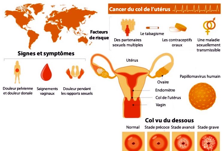 Cancer-du-col-de-l’utérus-symptomes