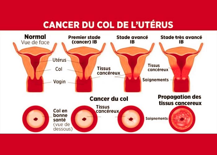 Cancer-du-col-de-l’utérus