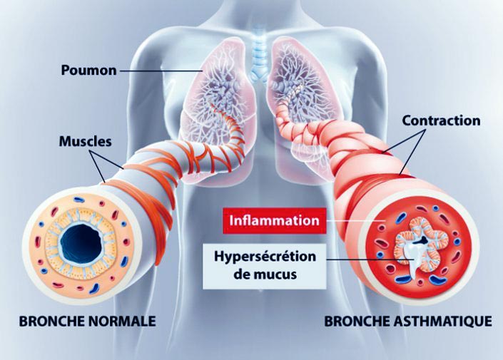 asthme-symptomes