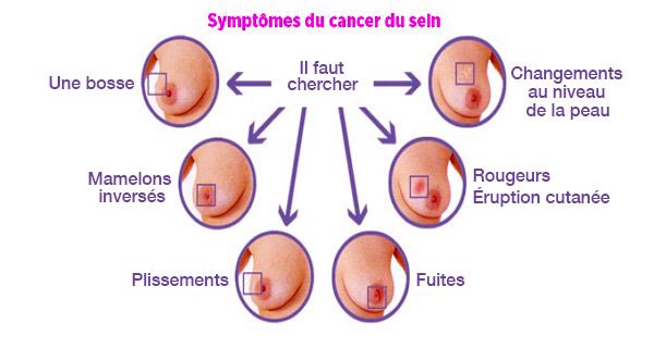 cancer-du-sein-Symptômes