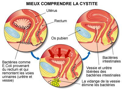 cystite-comprendre