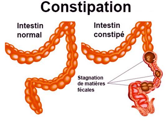 constipation-santé-senegal