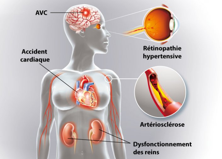 Hypertension : quels sont les symptômes