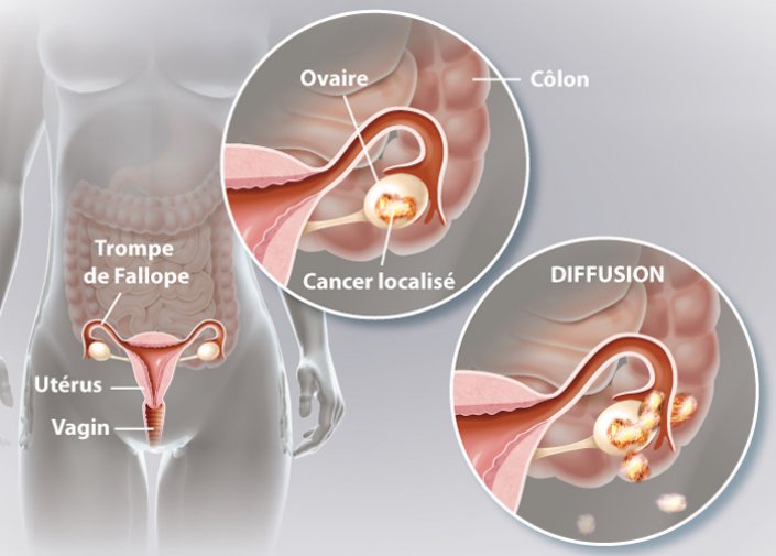 Le cancer de l'ovaire: symptômes, facteurs de risque, traitement