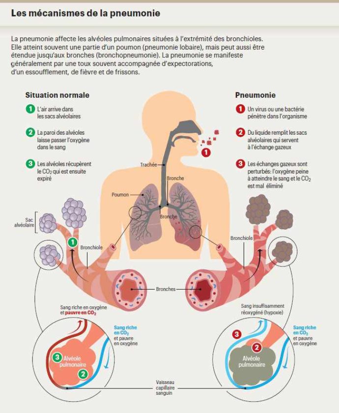 pneumonie-sante-senegal