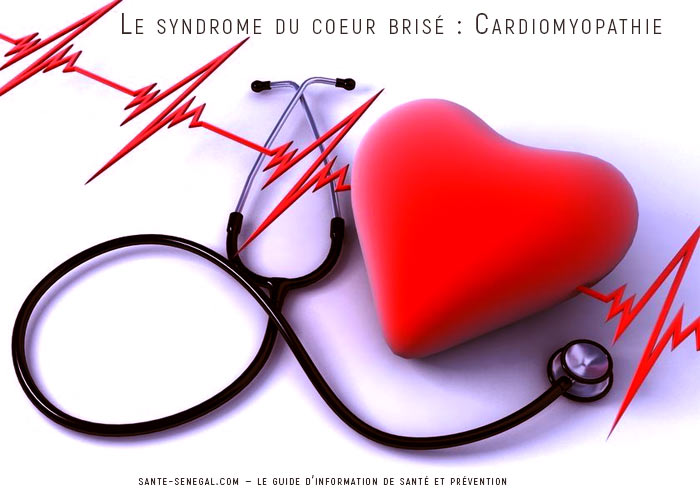 Le-syndrome-du-coeur-brisé-Cardiomyopathie