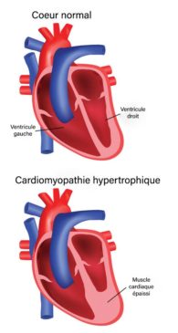 cardiomyopathie-hypertrophique