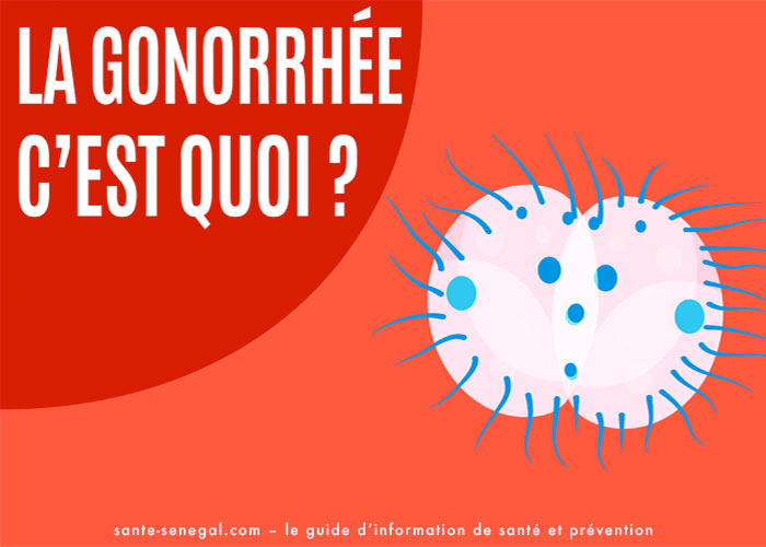 IST-Comment-soigner-la-gonorrhée