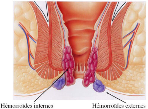 Crise hémorroïdaire : choisir le bon traitement