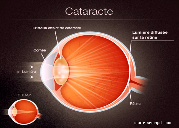 Cataracte-définition-symptômes-traitements