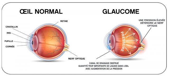 schema-cataracte-glaucome