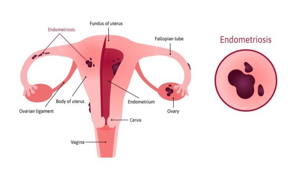 Endométriose-sante-senegal
