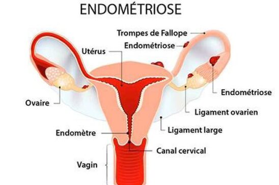 endometriose-infographie